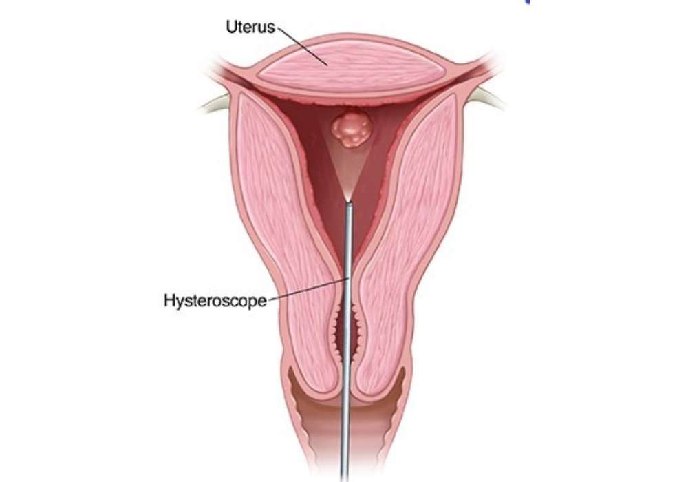 Hysteroscopy-polyp, fibroid, septum, synechiae