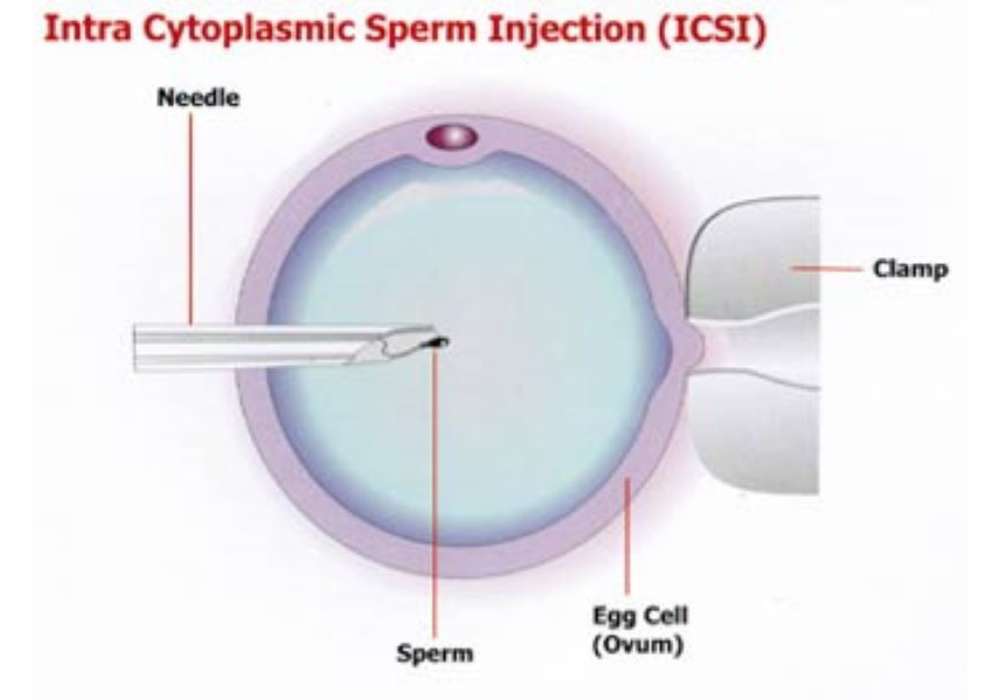 ICSI-Intra Cytoplasmic sperm Injection