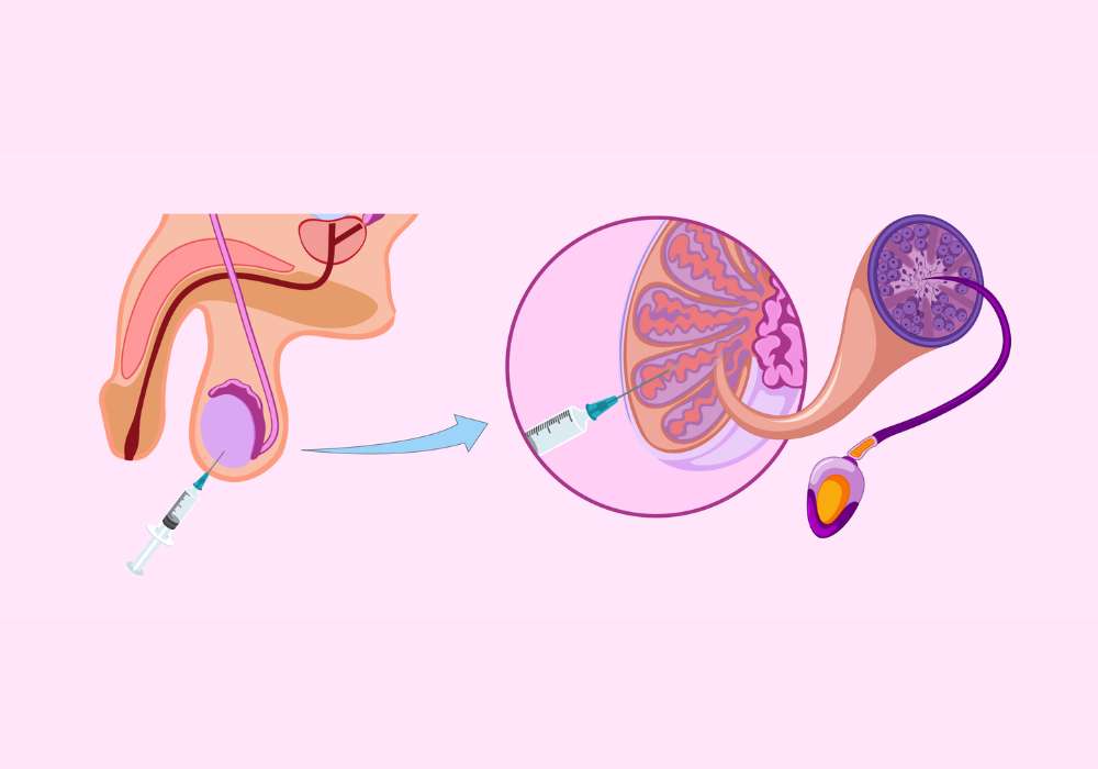 Testicular Epididymal Sperm Aspiration