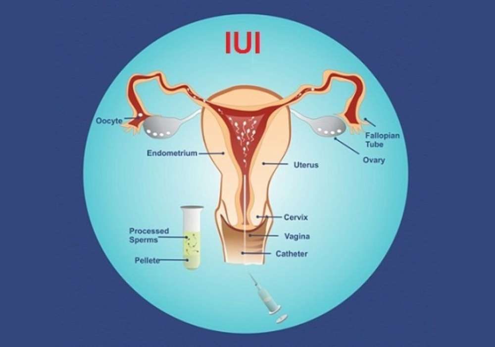 IUI-Intra Uterine Insemination - Self and Donor
