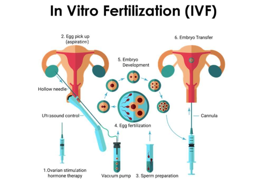 IVF-In Vitro Fertilization - Self, Donor egg, Donor sperm, Embryo Donat