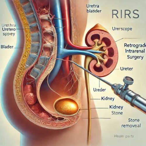 RIRS-Retrograde Intrarenal Surgery